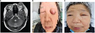 Case report: Isolated eyelid metastasis of ccRCC 5 years after receiving radical nephrectomy